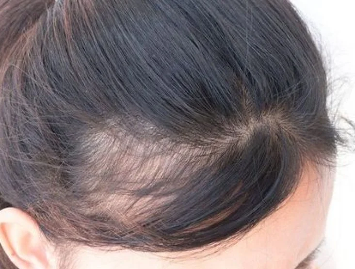 Alopecia - androgenic hair loss